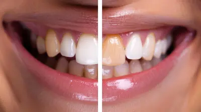 Common Myths About Teeth Whitening