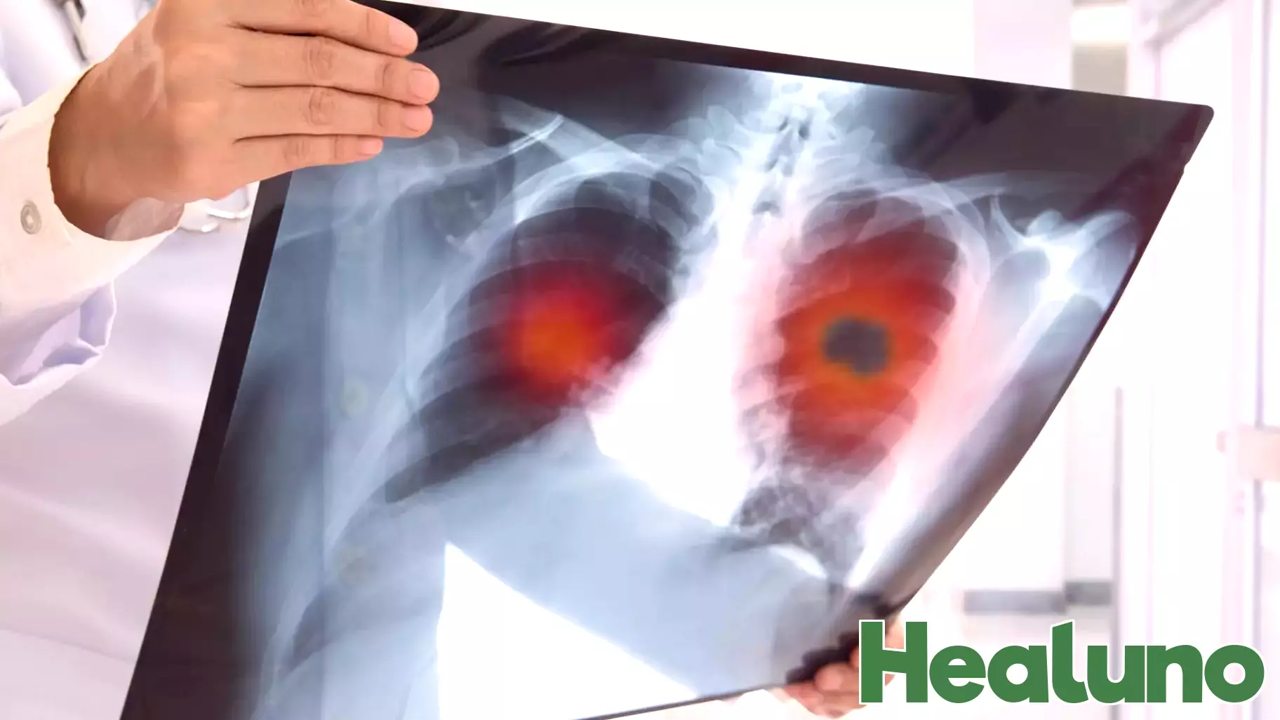 Early Indicators of Lung Cancer: What You Should Know