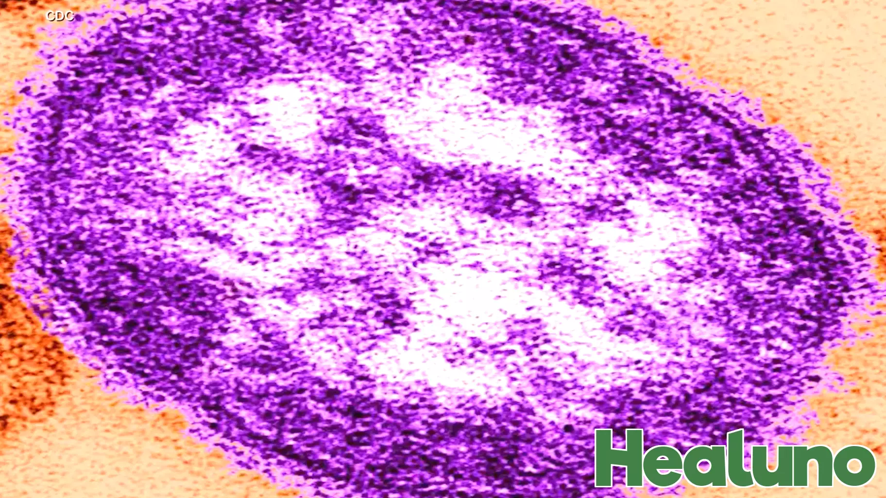 Health officials confirm Marathon County measles case linked to out-of-state travel