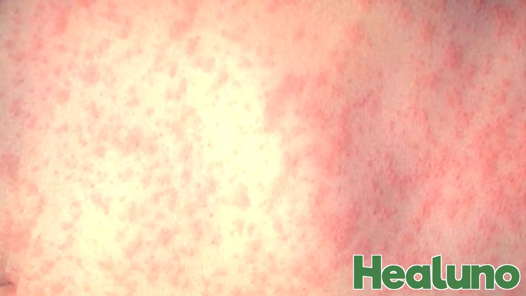 Health officials warn of measles exposure at Mt. Hood Community College campus in Gresham