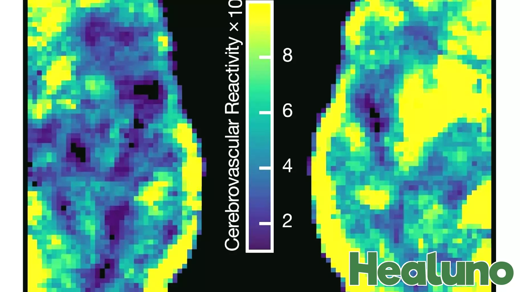 Innovative fMRI Analysis Reveals Surprising Brain Health Benefits in Older Women