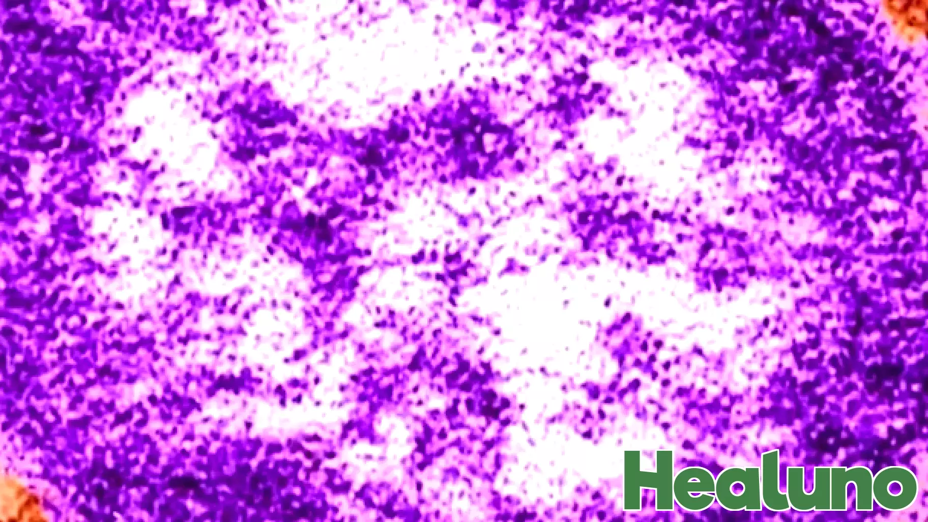 Measles Alert: Infected Passenger Flies from Boston to Miami