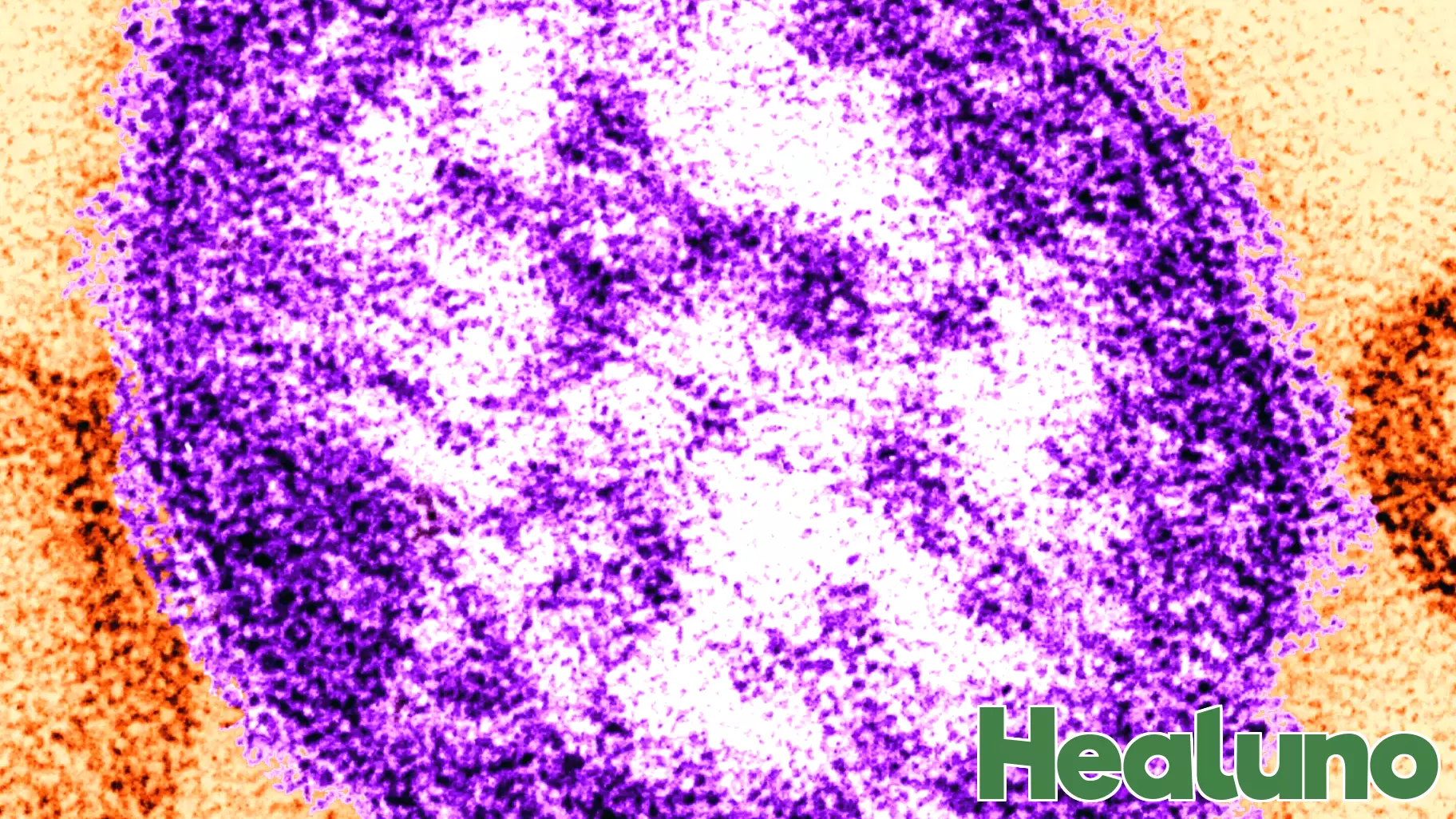 Philadelphia Reports Second Measles Case This Year