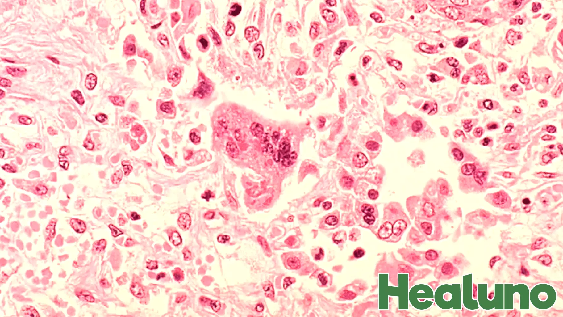 San Diego County health officials urge measles vaccinations amid nationwide surge