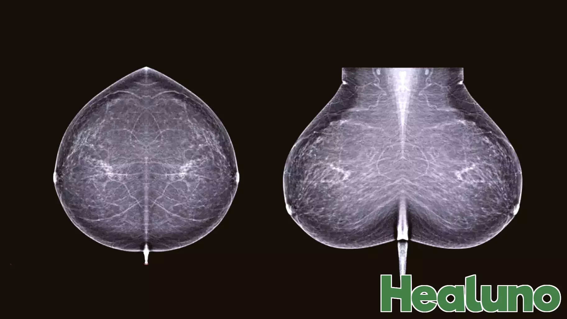 Startup Brings Breast Cancer Risk AI Straight to Patients