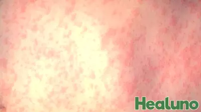 Health officials warn of measles exposure at Mt. Hood Community College campus in Gresham