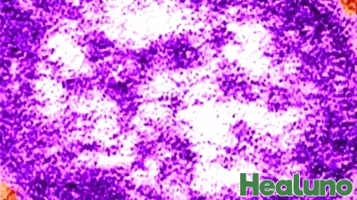 Measles Alert: Infected Passenger Flies from Boston to Miami