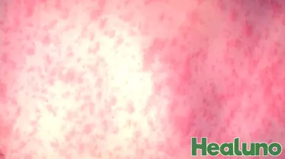 Measles Alert: Orange County Infant Travels Through LAX