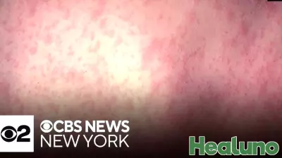 Measles Exposure Warning Issued for Mercer County Residents