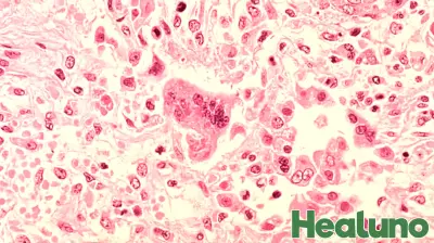 San Diego County health officials urge measles vaccinations amid nationwide surge