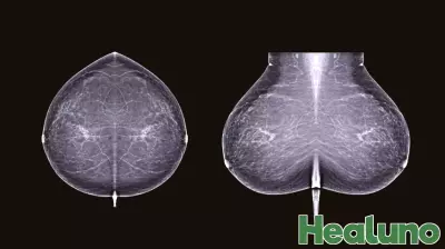 Startup Brings Breast Cancer Risk AI Straight to Patients