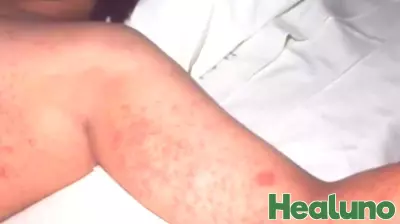 Texas Faces Severe Measles Outbreak with 48 Confirmed Cases